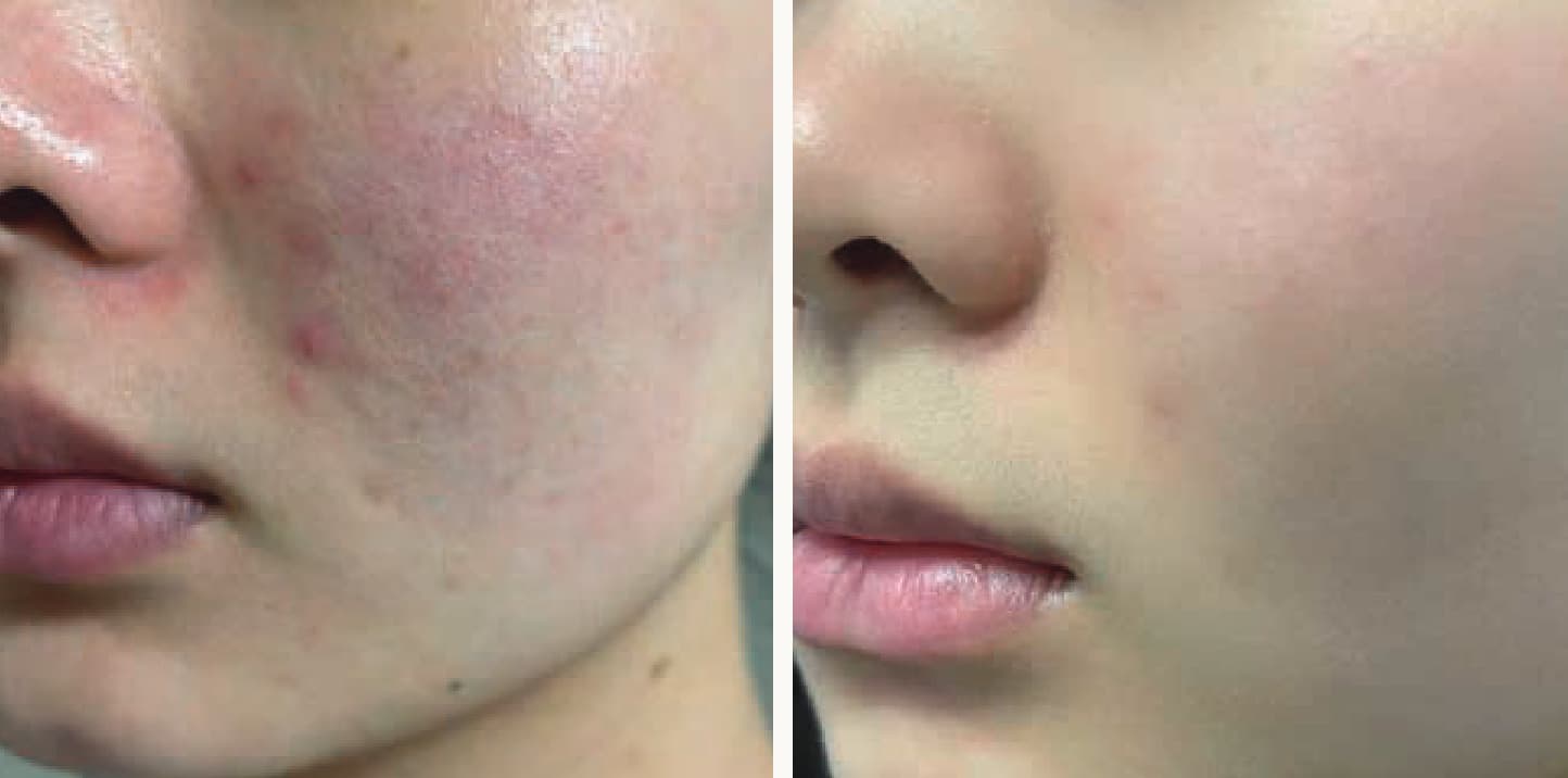 NOAV Spa Ampoule болон Booster Capsule хэрэглэсний өмнөх ба дараах үр дүн 4